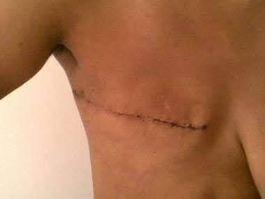 Surgical scar on a person's skin after chest or abdominal surgery.